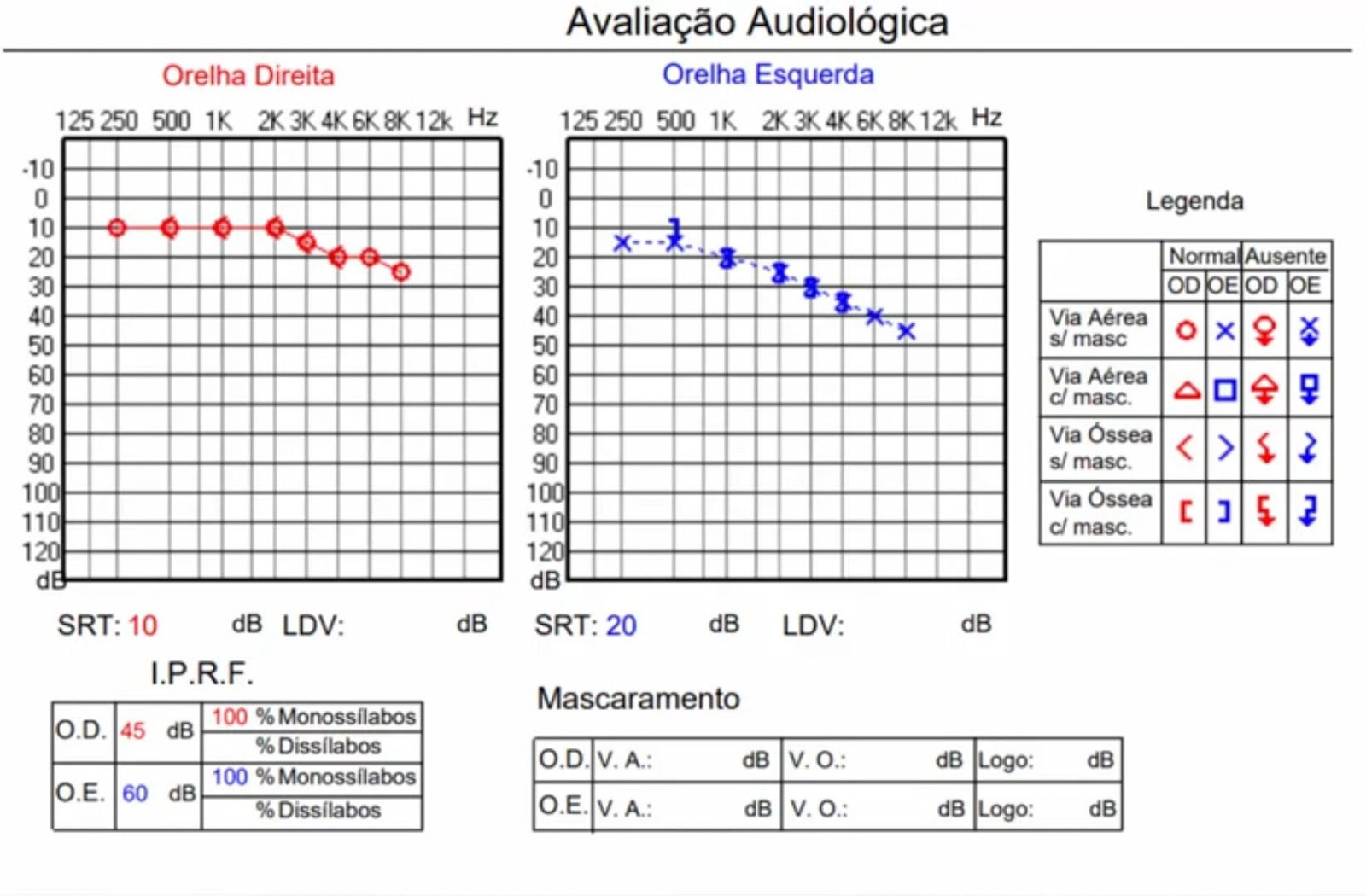 Como interpretar uma audiometria Veja o passo a passo