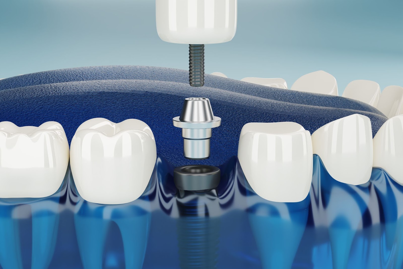 Implantes dentales que sustituyen una arcada completa de dientes perdidos