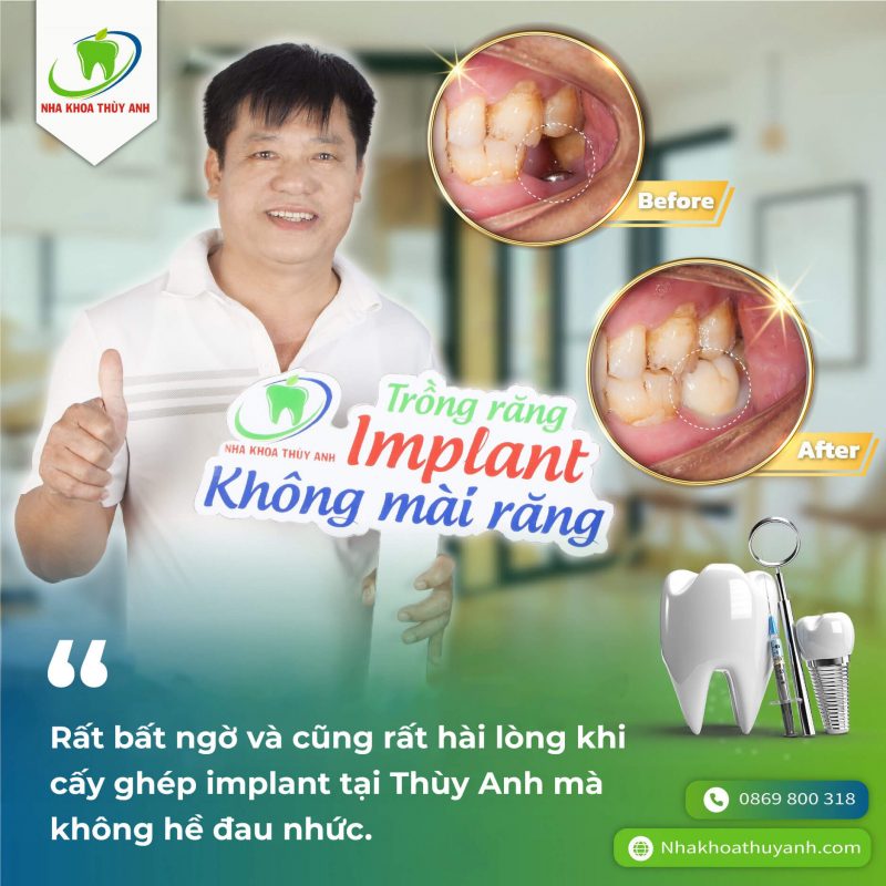 cay-ghep-implant-co-dau-khong-1 (1)