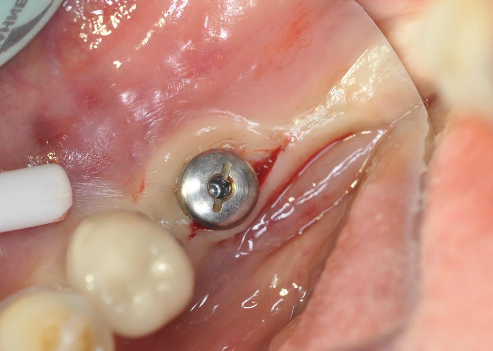 modified Kazanjian Vestibuloplasty for dentalimplant