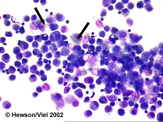 Fungal spores (arrows) free and phagocytosed by alveolar macrophages from BAL. Wright-Giemsa stain. Magnification: 600X.