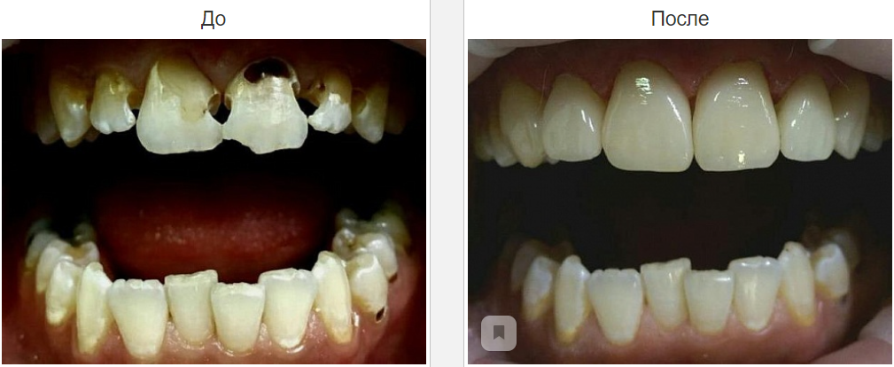 эстетическое восстановление зубов