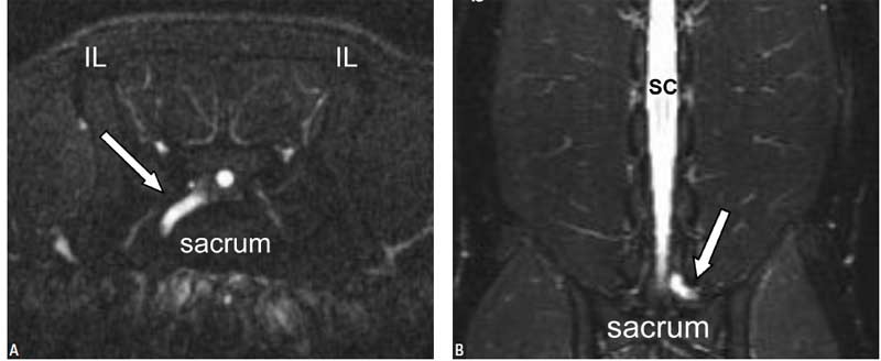 T2-weighted, transverse plane MRI image at the level of the lumbosacral joint of a dog & T2-weighted, coronal plane MRI image of the same dog