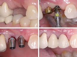 Dental-Implant-Supported-Bridge-at-Quintessence-Dental-Clinic-in-Bangalore.jpeg