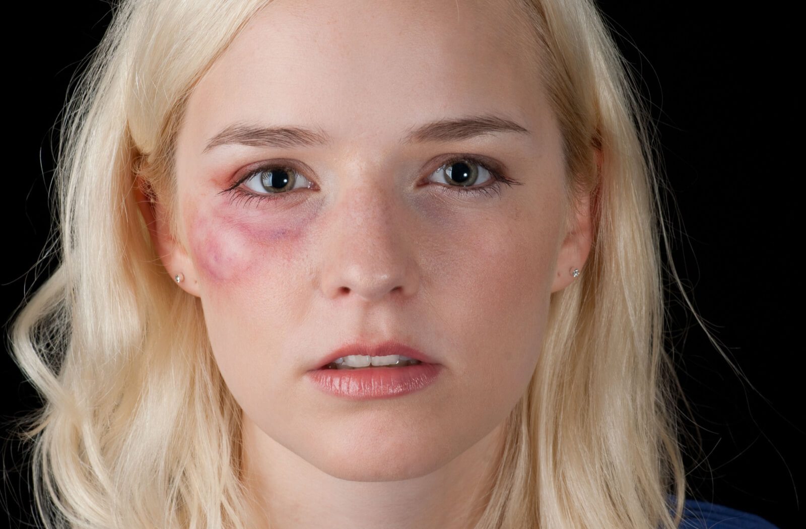 A close-up of a blonde woman with bruised cheeks against a black background.