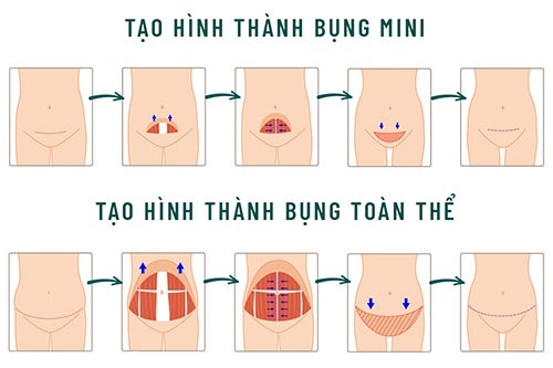 Hút mỡ tạo hình thành bụng mini và tạo hình thành bụng toàn phần