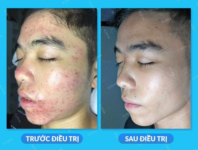 Da cải thiện hơn 98% sau liệu trình trị mụn tại O2 SKIN