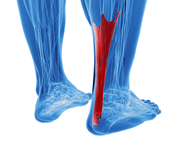 Lesion Tendinitis aquílea