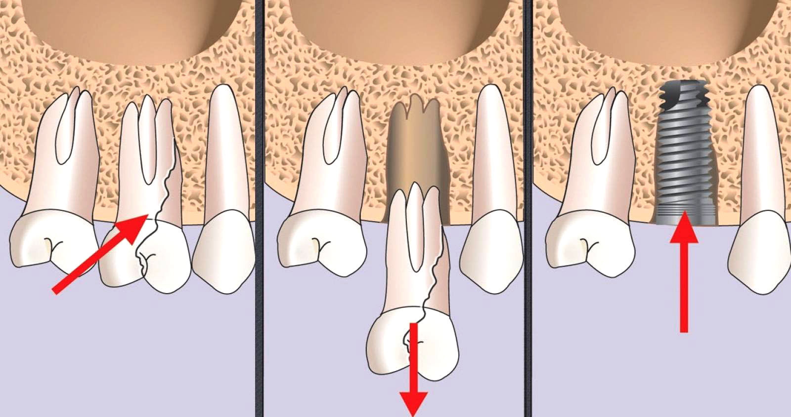 имплант операция зубной