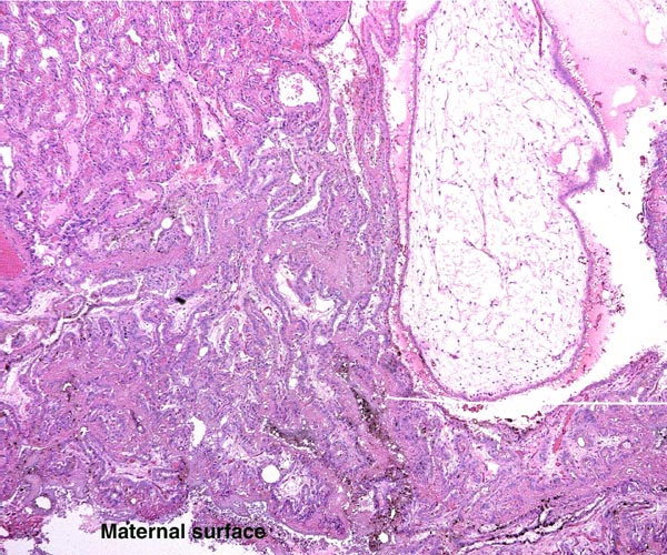 Focal edematous region in dog placenta