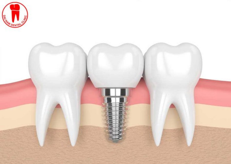 Nha khoa Đại Nam - cơ sở cấy ghép Implant uy tín và an toàn