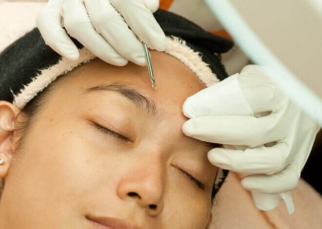 다낭 얼굴 관리는 여드름을 치료하고 예방하는 데 도움이 될 수 있습니다.