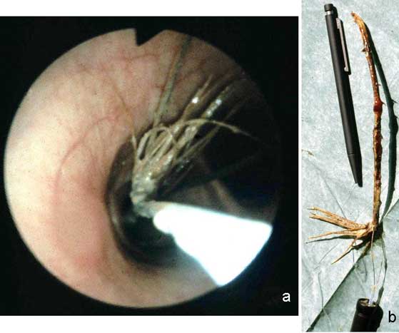 Foreign body (bramble) near the tracheal bifurcation (a) and transendoscopical removal using a wiresnare (b).