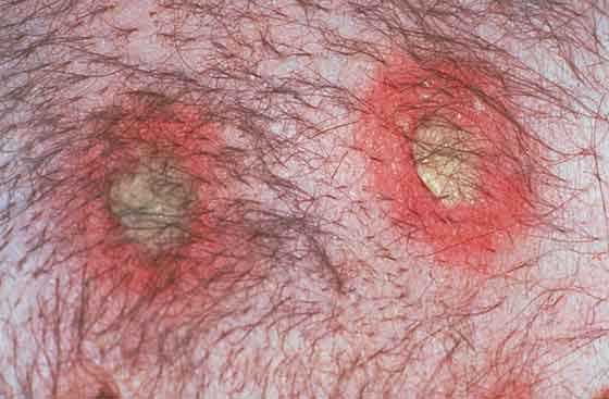 Pústula - Definición: una pequeña área circunscrita dentro de la epidermis llena de pus