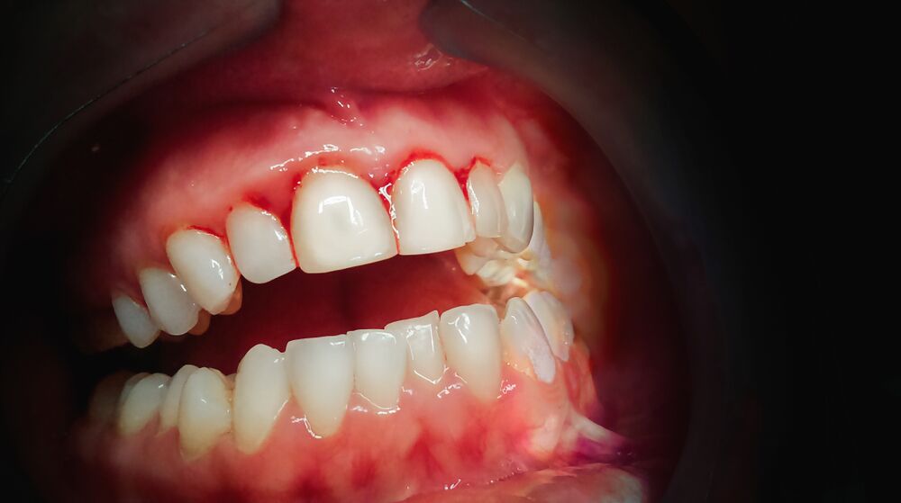 Gum Contouring | MPD