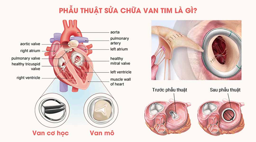 phau-thuat-sua-chua-van-tim-giup-giam-trieu-chung-nguoi-benh-van-tim