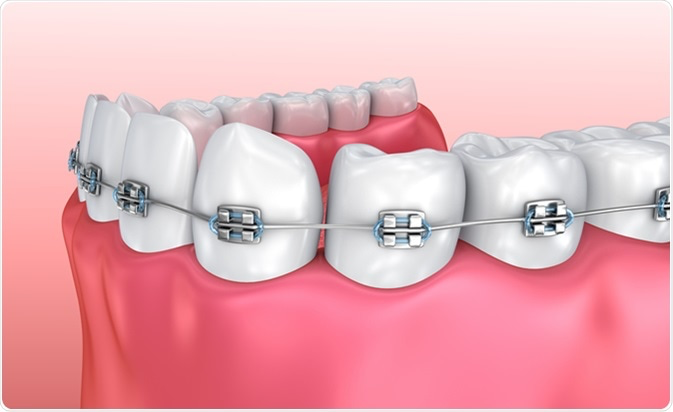 braces for human teeth