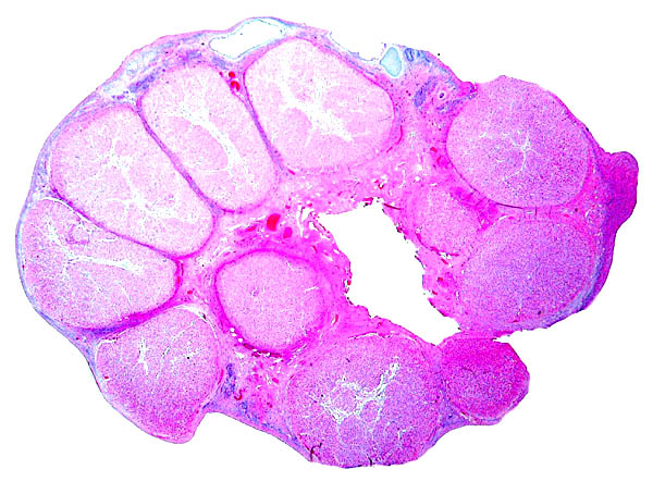 Both ovaries of the twin-bearing female had these numerous stimulated corpora. Which is the active corpus luteum could not be ascertained