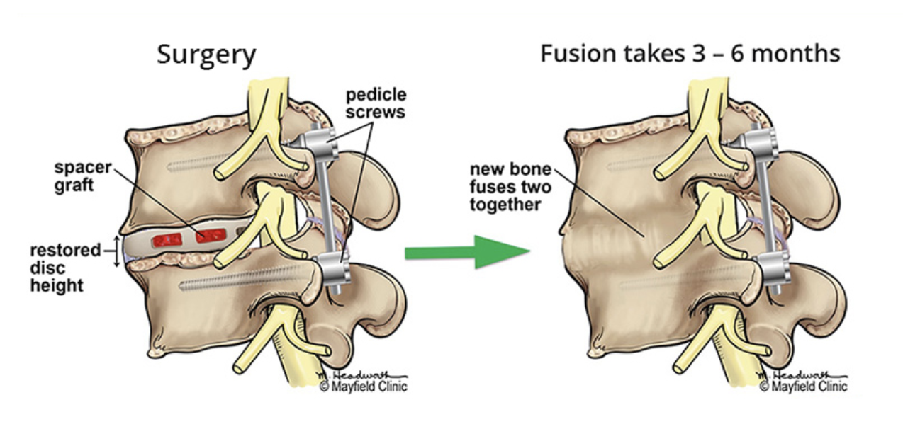 spinal-fusion