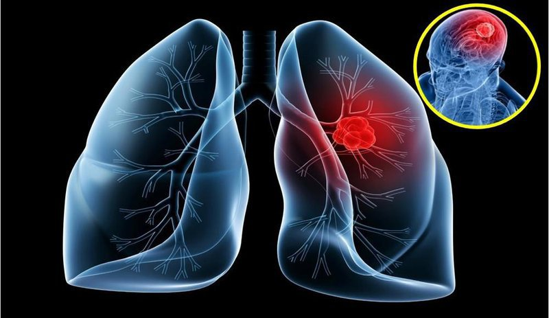 ung thư phổi sống được bao lâu,ung thư màng phổi sống được bao lâu,xạ trị ung thư phổi sống được bao lâu,ung thư phổi ác tính sống được bao lâu,ung thư phổi tái phát sống được bao lâu