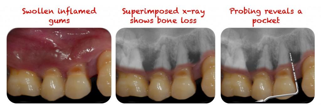 Image result for dental pockets xray