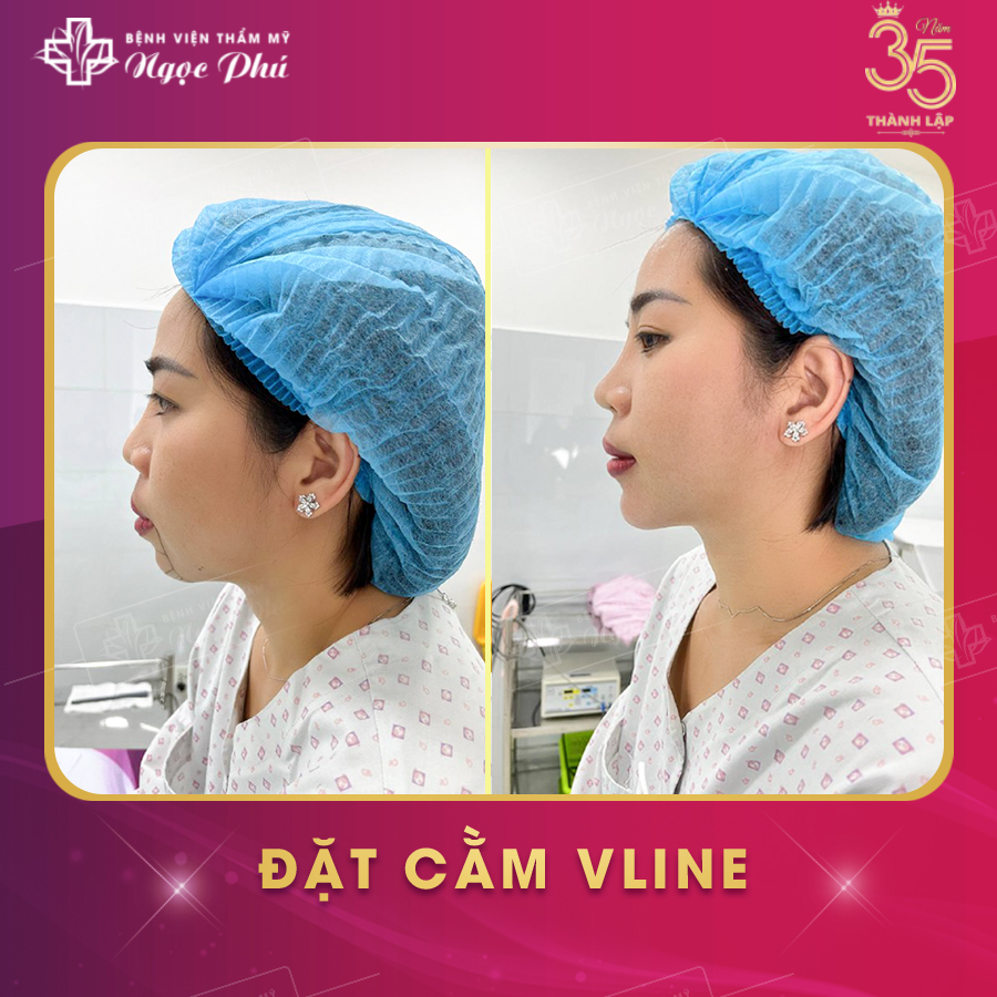 Khách hàng thực tế nâng mũi tại Thẩm Mỹ Việt Nam