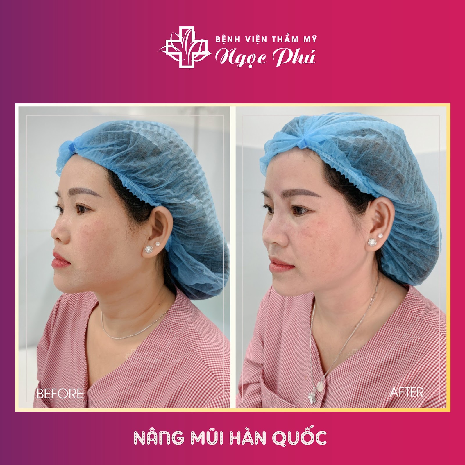 Sửa mũi Hàn Quốc ở đâu đẹp tại Thành Phố Hồ Chí Minh bất ngờ trở thành cụm từ khóa khá hot trong thời gian gần đây.