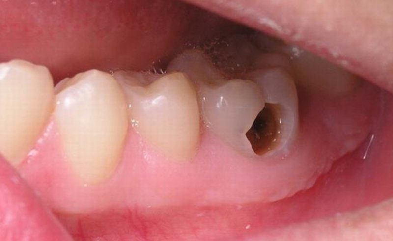 Răng viêm tủy nặng gây những cơn đau dữ dội