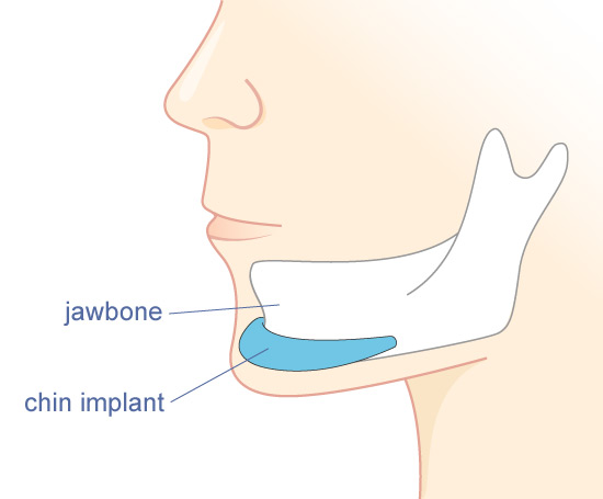 Xu hướng khuôn mặt V-line hiện đang rất được thịnh hành ở giới trẻ.