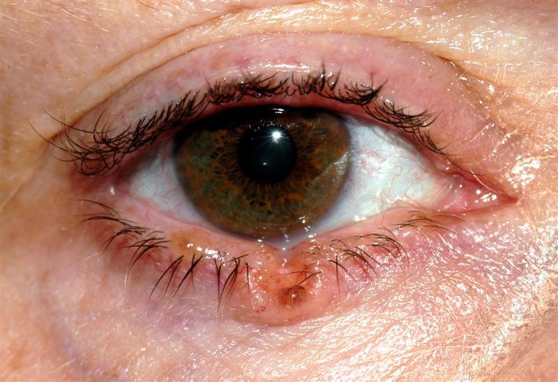 Αποτέλεσμα εικόνας για eyelid basal cell carcinoma