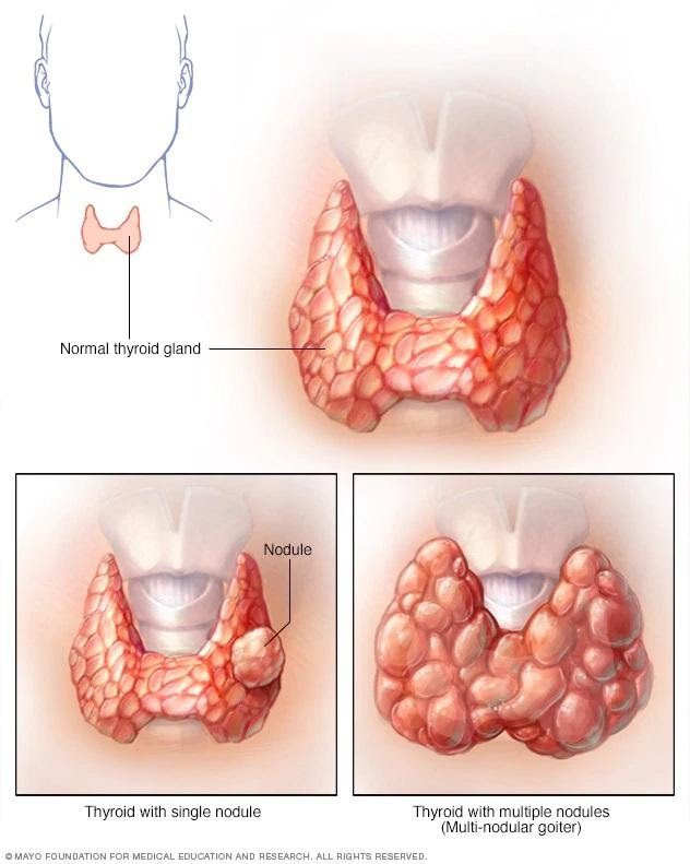 bướu đa nhân tuyến giáp,bướu đa nhân tuyến giáp là gì,bướu đa nhân tuyến giáp lành tính,bệnh bướu đa nhân tuyến giáp,bướu đa nhân tuyến giáp kiêng ăn gì