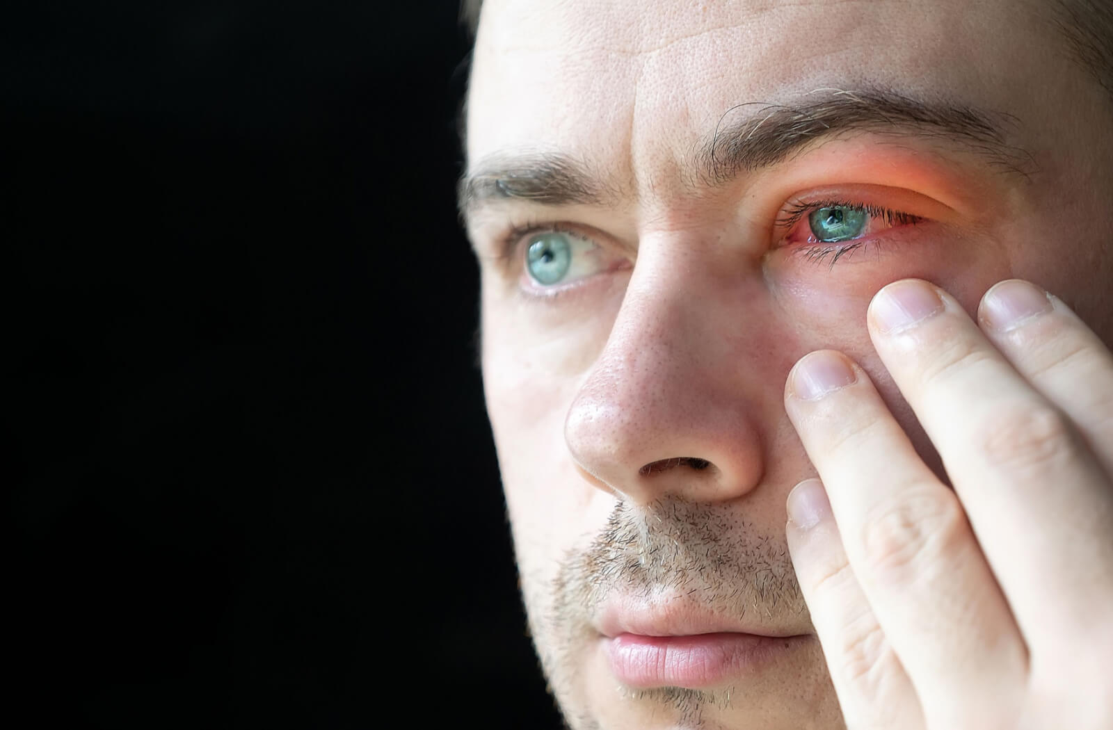 A close-up of a man touching his severely bloodshot eye,  itchy, swollen, and redness on the lining of the eyelids are common symptoms of Blepharitis. BlephEx is one treatment option that can relieve symptoms by removing the blockages that lead to dry eyes for longer-lasting relief.