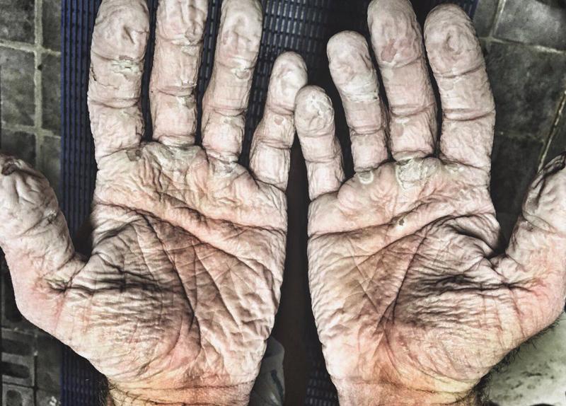 
Sau khi ngâm mình quá lâu trong nước với đôi găng tay ướt sũng, đôi bàn tay của vận động viên đua thuyền người Anh Alex Gregory trở nên nhăn nhúm, nước thấm qua các vết tróc khiến cho chúng sưng phồng lên.