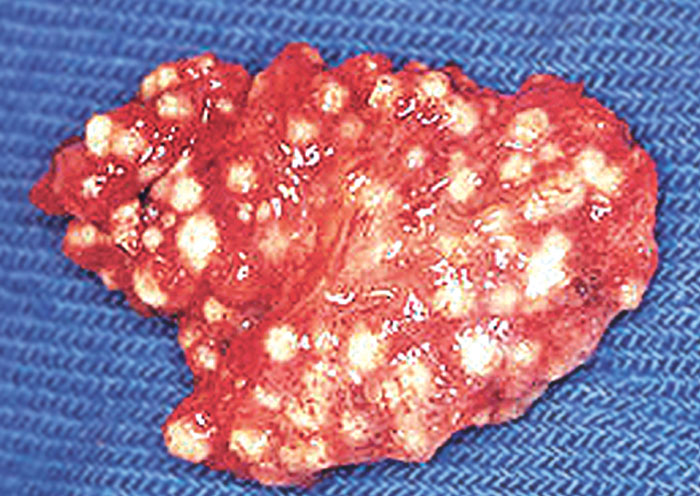Miliary lung nodules due to inhalation of Aspergillus spp. spores
