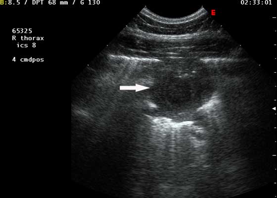 Sonogram of a pulmonary abscess obtained from the right lung in the 8th intercostal space from a foal with Rhodococcus equi pneumonia.