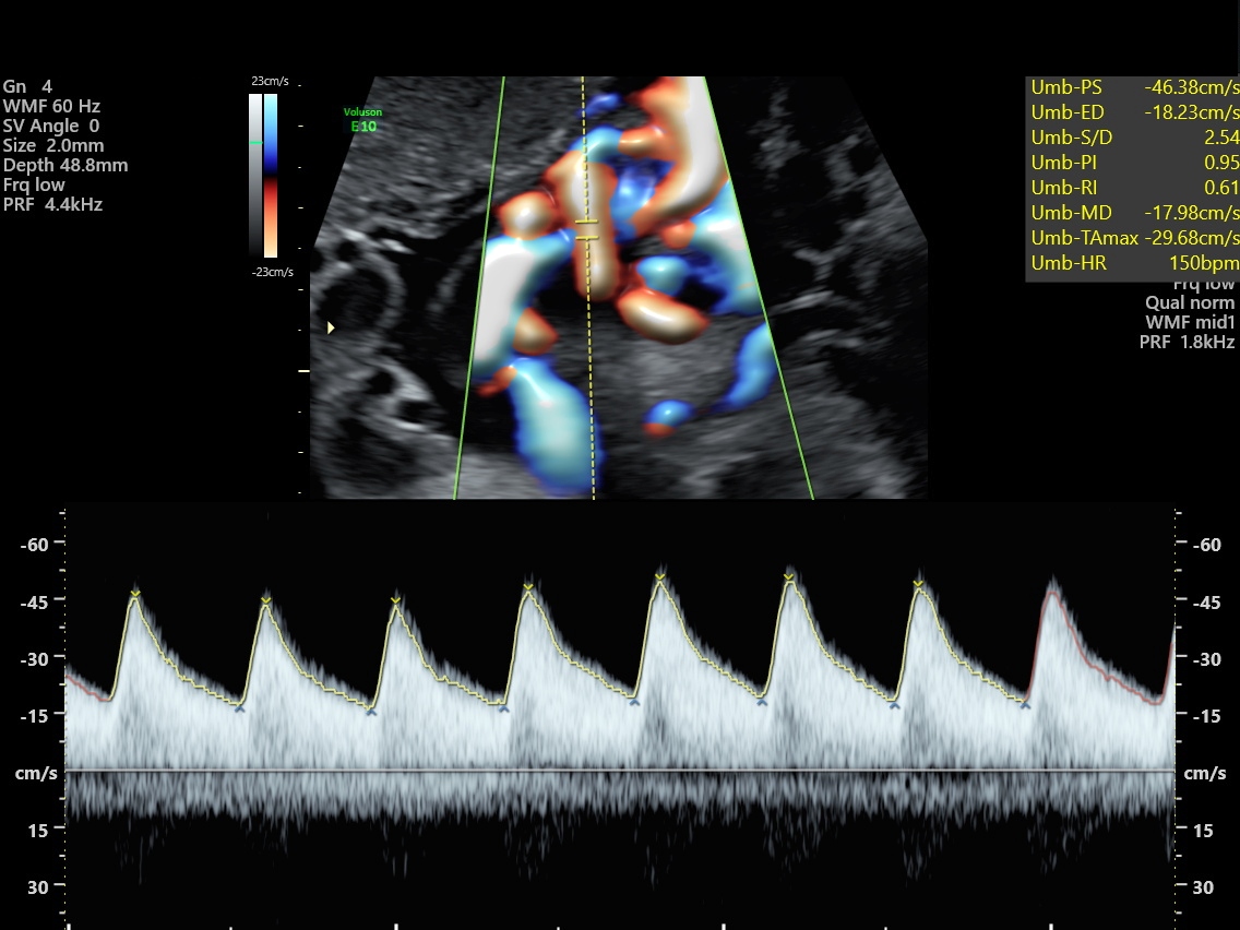 Umbilical Artery Doppler – Sonographic Tendencies