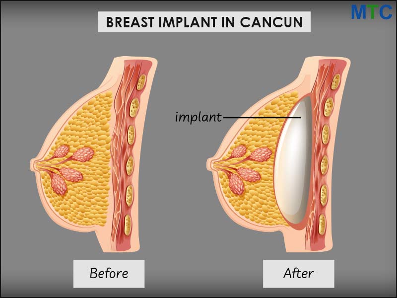 Breast Implants: The Benefits And Risks Of Different Implant Materials 2023