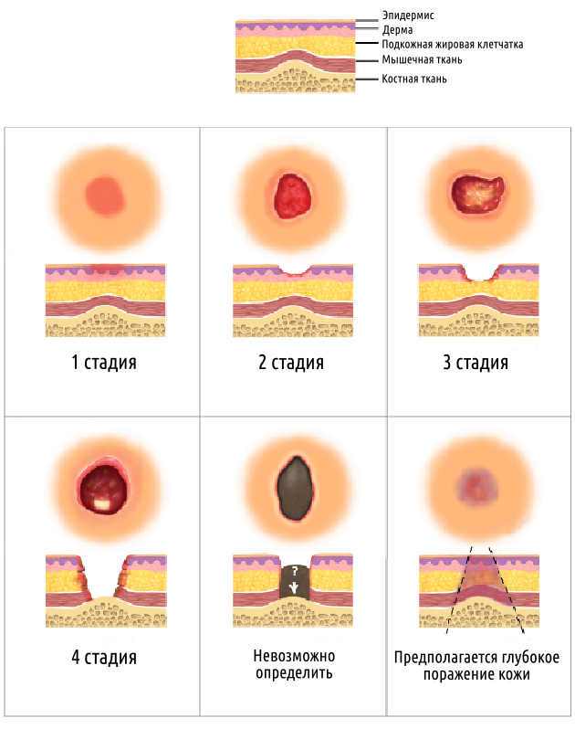 Пролежни На Ногах Фото