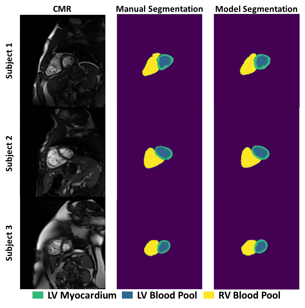 Manual vs. Machine learning-derived short-axis cardiac MRI segmentations in patients with tetralogy of Fallot. Thompson et al., ISMRM 2022.