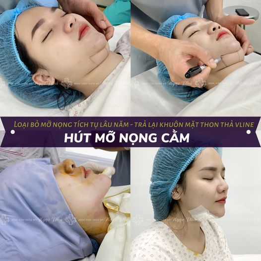 Hiện nay, có nhiều công nghệ hút mỡ cằm, trong đó, tiêu biểu nhất vẫn là hút mỡ nội soi.