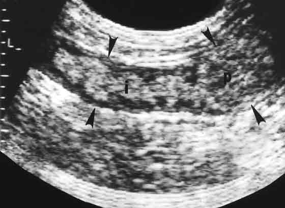Posparto 3 semanas, involución uterina normal
