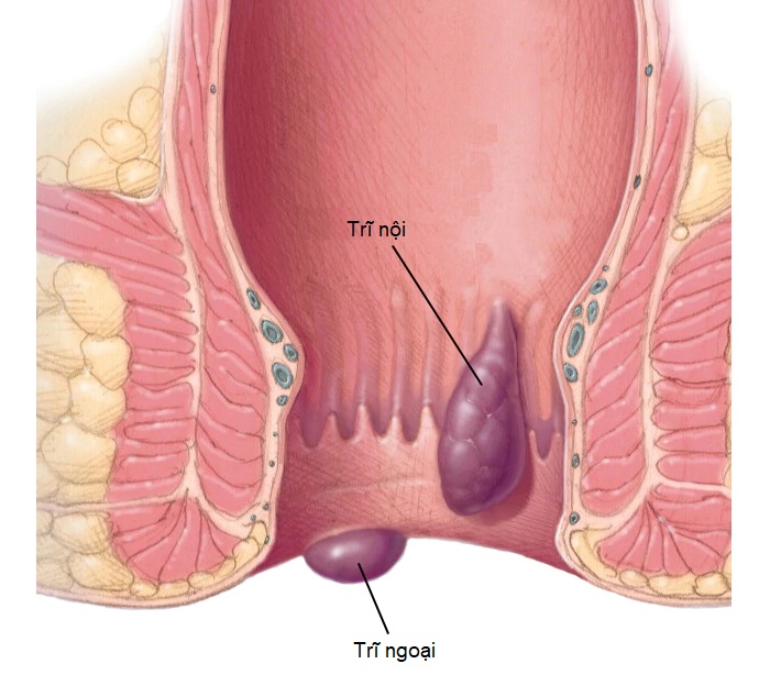 Bệnh trĩ được phân loại như thế nào?