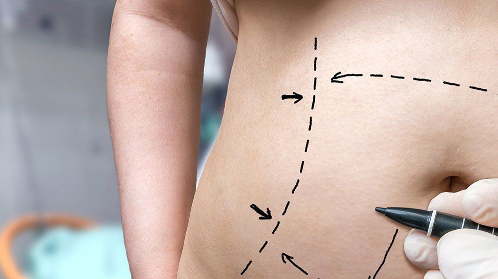 Why Am I Losing Weight After Hernia Surgery
