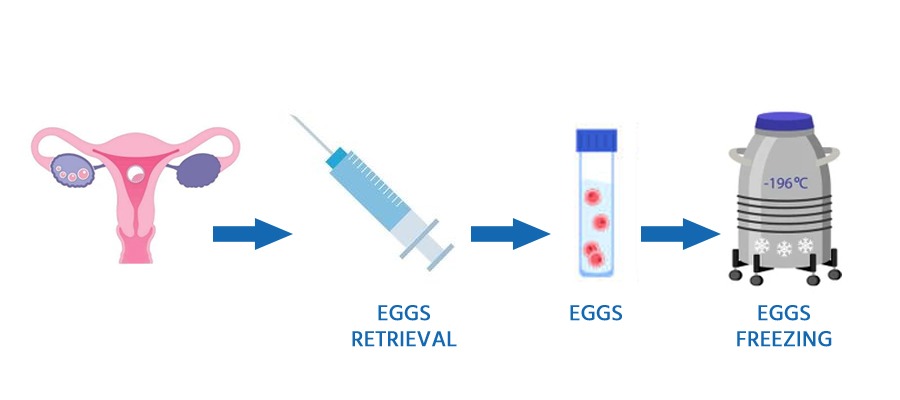 egg freezing process in Chennai