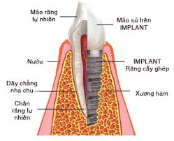 Lợi ích của implant là gì? HyR270NFNZeQckrgTIZ7x03DSQBX5bIaU8TQ9VwD6DXlVywZqSoBPKmaFjVzDio-YayOGesKhafm0vuR3dHYwjOZkUNjXoCAd_FOVKPEl2zCUyxrbYPYdrIsvmKfgayMVb7WGtne