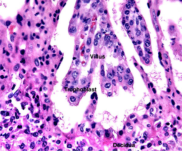 Two immature villi interdigitate with endometrium (below). Note the giant nuclei of the endometrial epithelium