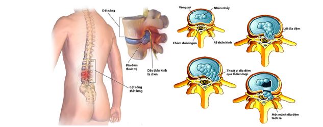 Bệnh Thoát Vị Đĩa Đệm: Nguyên Nhân, Triệu Chứng, Đối Tượng Dễ Mắc Và Cách Điều Trị Hiệu Quả