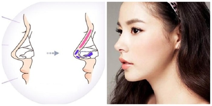 Sụn sườn tự thân có khả năng tái lập lại cấu trúc của mũi