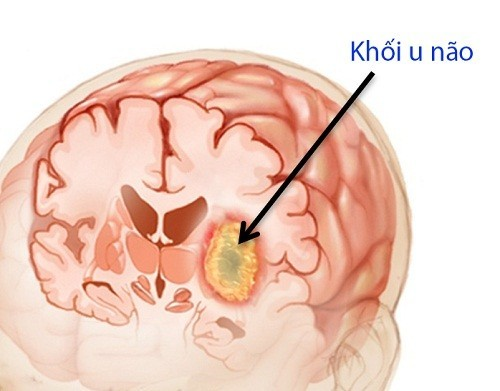 Bệnh u não là gì? Có nguy hiểm không?