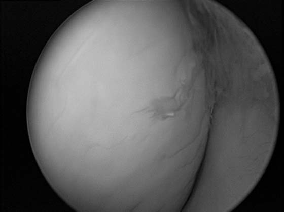 Arthroscopic view of medial femorotibial joint treated with direct IA injection of fat-based stem cells (note focal erosion on medial femoral condyle).